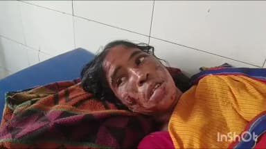 गावां: पति और सास ने महिला को गरम छोलनी से जलाया, गंभीर हालत में अस्पताल में भर्ती