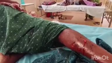 టెక్కలి: టెక్కలి మండలంలోని నరసింగపల్లి తదితర ప్రాంతాల్లో పిచ్చికుక్క స్వైర విహారం, 9 మందికి గాయాలు