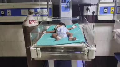 बरेली: बरेली के डॉक्टरों ने 2 घंटे में किया मेडिकल चमत्कार, 3 महीने के मासूम के पेट में पल रहा था दूसरा भ्रूण