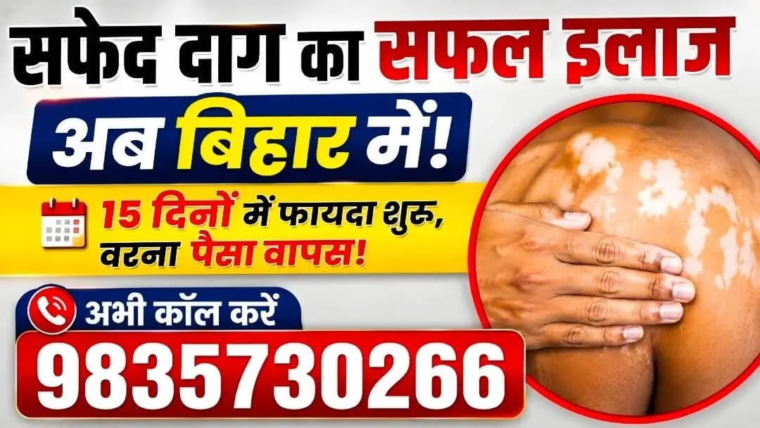 मधेपुरा: अब बिहार में हो रहा है सफेद दाग का सफल ईलाज, 15 दिनों में दवा का असर शुरू वरना पैसे वापस | 9835730266