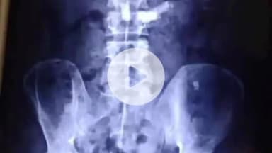 కూకట్పల్లి: హైదరాబాద్ కి చెందిన 37 ఏళ్ల వ్యక్తి మానసిక వ్యాధితో బ్లేడ్లను మింగడంతో సర్జరీ ద్వారా తొలగించిన వైద్యులు