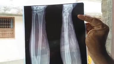 কালিয়াচক ১: জীবন্ত মানুষের শরীরে অসংখ্য সুচ! মালদার কালিয়াচকের সুলতান গঞ্জে যুবকের দেহে এই সুচ কাণ্ডে আতঙ্কিত এলাকাবাসীরা