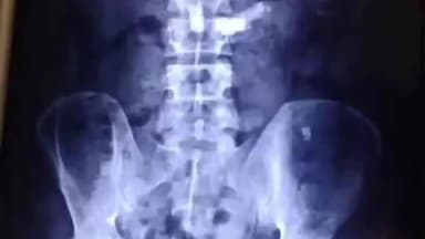 కూకట్పల్లి: హైదరాబాద్ కి చెందిన 37 ఏళ్ల వ్యక్తి మానసిక వ్యాధితో బ్లేడ్లను మింగడంతో సర్జరీ ద్వారా తొలగించిన వైద్యులు