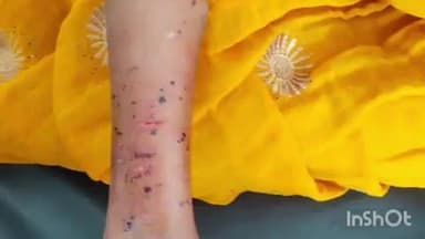 ब्यौहारी: ब्यौहारी अस्पताल में घायल महिला का इलाज जारी, पारिवारिक विवाद में हुई मारपीट