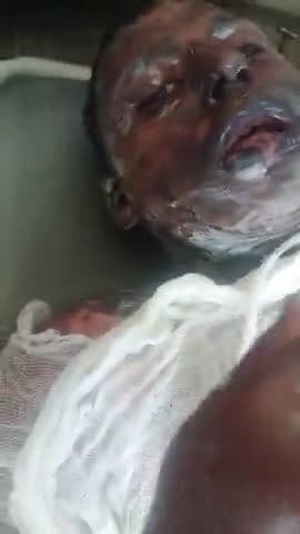 jale ladke ne apne muh se bayan diye baba ke khilafh jise use jalaya tha