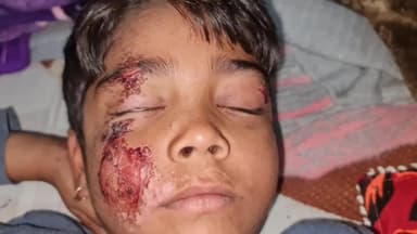 लिधौरा: बाइक की टक्कर से 7 वर्षीय बालक घायल, पिता ने लगाए आरोप, इलाज जारी