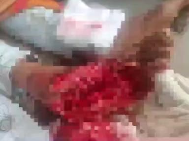 बाह: पिनाहट में आलू बुबाई मशीन में पैर फंसने से किशोर घायल