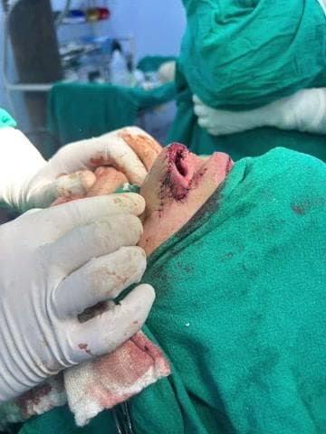 चमोली: गोपेश्वर चिकित्सालय में कुत्ते के काटने से क्षतिग्रस्त नाक का सफल पुनर्निर्माण, 23 वर्षीय साजन सिंह को मिली नई जिंदगी