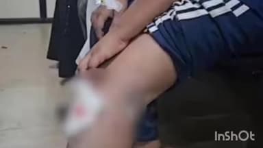 വടകര: നാദാപുരത്ത് തെരുവ് നായ ആക്രമണത്തിൽ സഹോദരങ്ങൾ ഉൾപ്പടെ മൂന്ന് കുട്ടികൾക്ക് പരുക്കേറ്റു