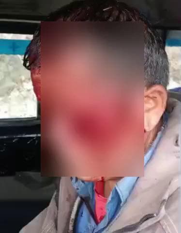 थराली: थराली विकासखंड के सगवाड़ा में भालू के हमले में एक व्यक्ति गंभीर घायल, हायर सेंटर किया गया रेफर