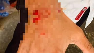 মন্দিরবাজার: দক্ষিণ বিষ্ণুপুর এলাকায় স্কুটি ও বাইকের সংঘর্ষে আহত স্কুটি আরোহী।