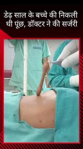 डेढ़ साल के बच्चे की पूंछ निकली, बलरामपुर अस्पताल में हुई सर्जरी