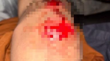 মন্দিরবাজার: লক্ষীকান্তপুর এলাকায় একটি বাইক নিয়ন্ত্রণ হারিয়ে এক সাইকেল আরোহীকে ধাক্কা মারে আহত সাইকেল আরোহী