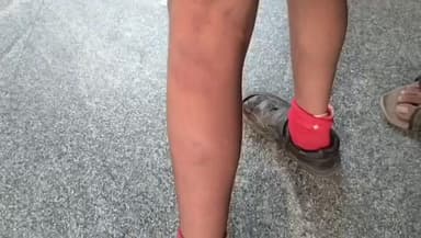 ಕಂಪ್ಲಿ: ನಗರದ ಶಾಸಗಿ ಶಾಲೆಯಲ್ಲಿ ವಿದ್ಯಾರ್ಥಿಗೆ ಬಾಸುಂಡೆ ಬರುವಂತೆ ಹೊಡೆದ ಶಿಕ್ಷಕಿ; ಪೋಷಕರ ಆಕ್ರೋಶ