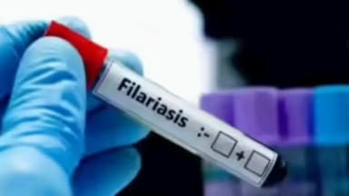 उदवंत नगर: फाइलेरिया के रेड जोन में पहुंचा उदवंतनगर, स्वास्थ्य विभाग चलाएगा विशेष अभियान, हुआ सतर्क