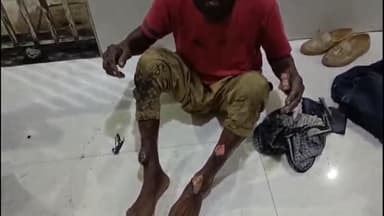 नागौद: नागौद के पेट्रोल पंप पर गैलन में पेट्रोल भरते समय लगी आग, 2 बच्चों समेत 5 लोग झुलसे