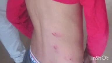 सोहागपुर: पालतू कुत्ते के काटने से 7 वर्षीय मासूम घायल, मालिक के खिलाफ मामला दर्ज