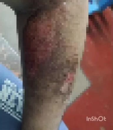 पेटलावद: ग्राम उन्नई के पास बाइक सवार असंतुलित होकर दुर्घटनाग्रस्त