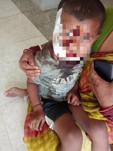 टेढ़ागाछ: टेढ़ागाछ प्रखंड के पिपरा गांव में पागल कुत्ते का आतंक, कई बच्चे घायल