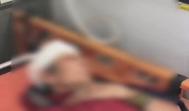 कटनी के इमलिया में बंदरों का आतंक, महिला पर हमला, ज़िला अस्पताल में भर्ती