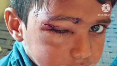 పాలకుర్తి: పాలకుర్తి మండల కేంద్రంలో కుక్కల స్వైర విహారం, పలువురిని గాయపరిచిన వీధి కుక్కలు, స్థానిక ప్రభుత్వాసుపత్రికి తరలింపు