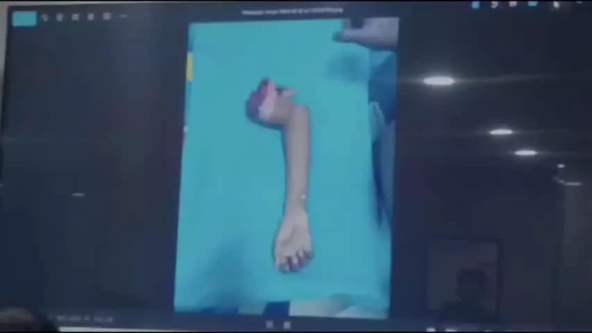 रोहतक: कंधे से कटा पूरा हाथ, युवक जुड़वाने अस्पताल पहुंचा:रोहतक में डॉक्टरों ने 7 घंटे चली सर्जरी के बाद जोड़ा; मूवमेंट करने लगा