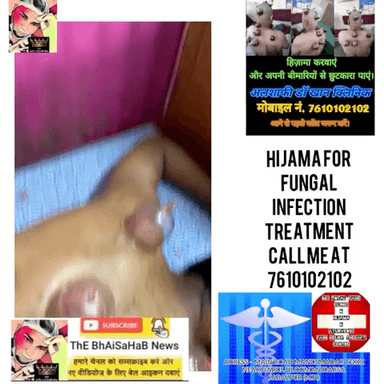 Hijama for back in severe fungal treatment available in jabalpur India
#hijama #viral