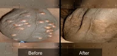 Removal of Cyst
 
#skin_diseases
#skin_infection
#doctor_Amethi