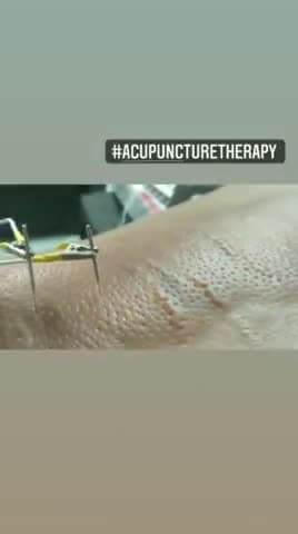#कमर_दर्द_घुटने_दर्द_गर्दन_दर्द मे तुरन्त आराम आयुर्वेद से #acupuncture_therapy डाँ. हेमराज सेन
पण्डेर 9982437471