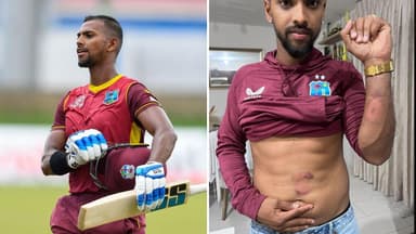 निकोलस पूरन ने शेयर की भारत के खिलाफ 5वें टी20I में उन्हें लगे चोट के निशान की तस्वीर #पूरन #क्रिकेट