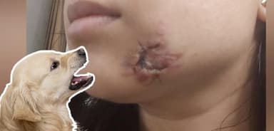 नोएडा की सोसायटी में कुत्ते ने महिला डॉक्टर के गाल पर काटा, मालिक के खिलाफ केस दर्ज #कुत्ता