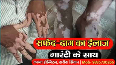 गौतम बुद्ध नगर: सिवान जिले के काव्या हॉस्पिटल में सफेद दाग का गारंटी के साथ हो रहा है इलाज, दवा का असर नहीं तो पैसा वापस | 9835730266